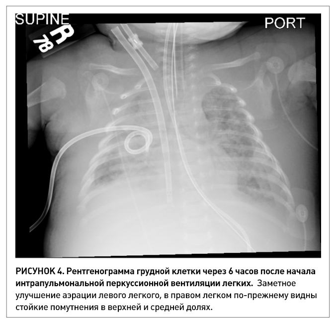 ИПВ коклюш 04.png