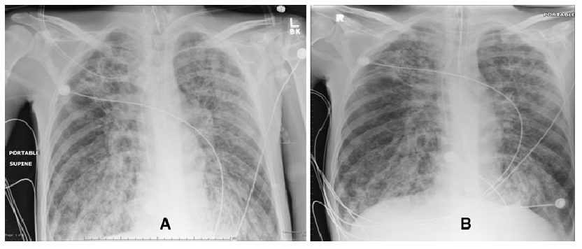 cf-lungs.png