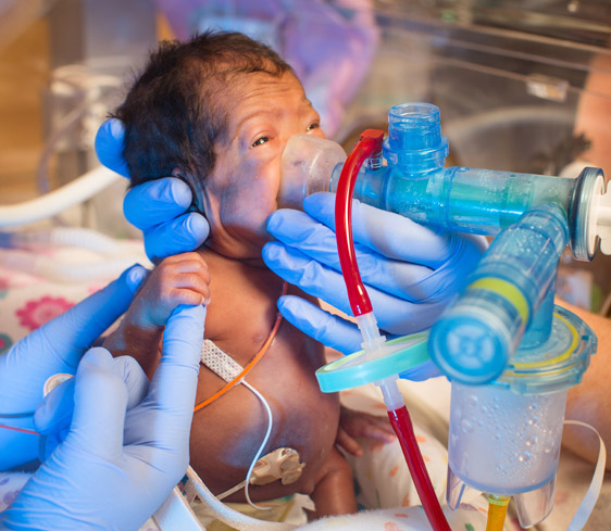 ИПВ при тяжелой респираторной дисфункции у детей с крайне низким гестационным возрастом